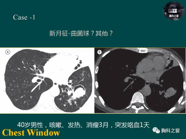 【PPT】肺结核假性动脉瘤