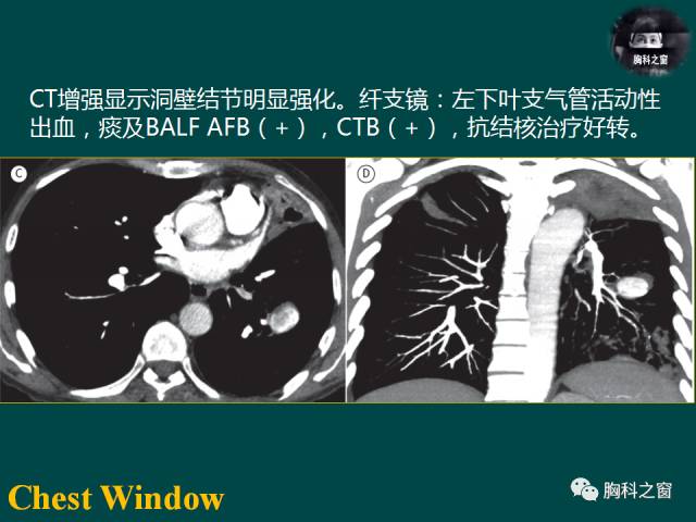 【PPT】肺结核假性动脉瘤