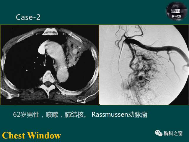 【PPT】肺结核假性动脉瘤