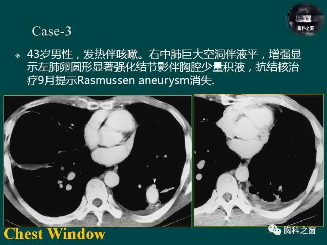 【PPT】肺结核假性动脉瘤