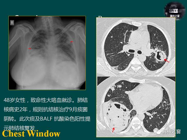 【PPT】肺结核假性动脉瘤