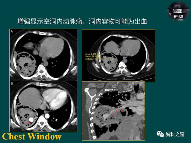 【PPT】肺结核假性动脉瘤
