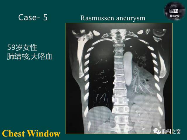 【PPT】肺结核假性动脉瘤