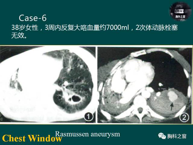 【PPT】肺结核假性动脉瘤