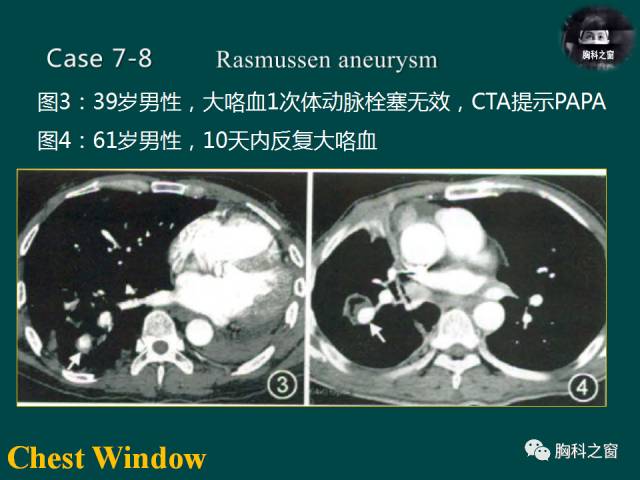 【PPT】肺结核假性动脉瘤