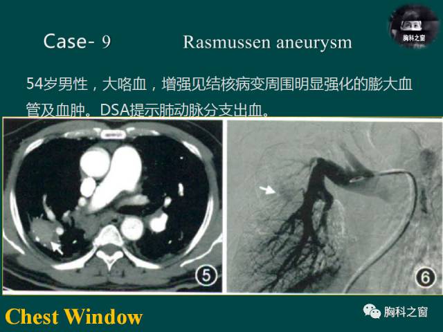 【PPT】肺结核假性动脉瘤