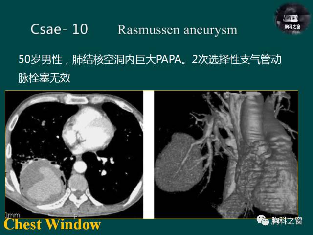【PPT】肺结核假性动脉瘤