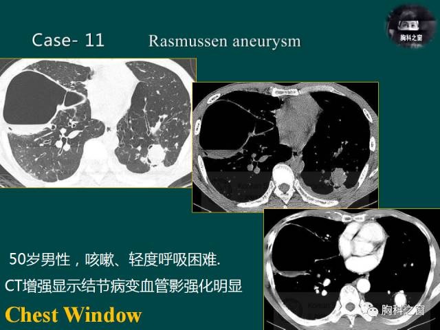 【PPT】肺结核假性动脉瘤