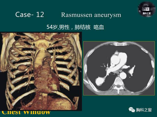 【PPT】肺结核假性动脉瘤