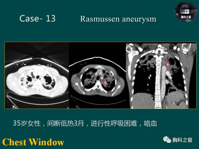 【PPT】肺结核假性动脉瘤