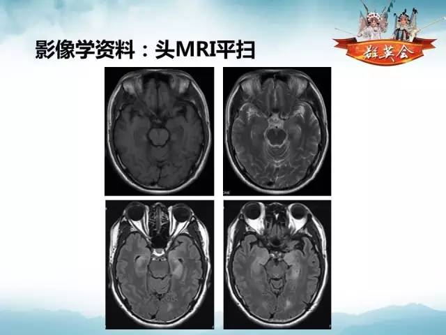 【病例】自身免疫性脑炎1例MR