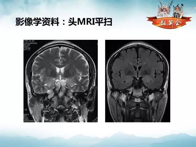【病例】自身免疫性脑炎1例MR