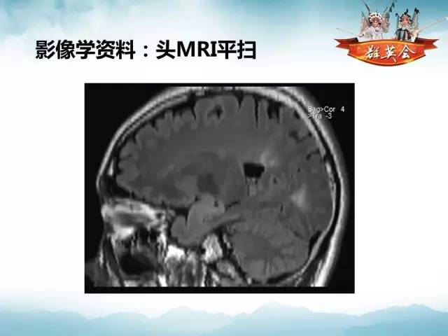 【病例】自身免疫性脑炎1例MR