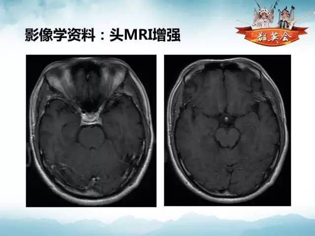 【病例】自身免疫性脑炎1例MR