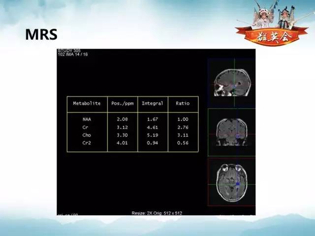 【病例】自身免疫性脑炎1例MR