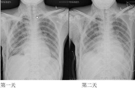 胸部影像学征象——肺部 胸部影像学征象——肺部