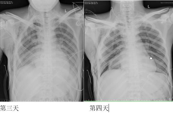 胸部影像学征象——肺部 胸部影像学征象——肺部