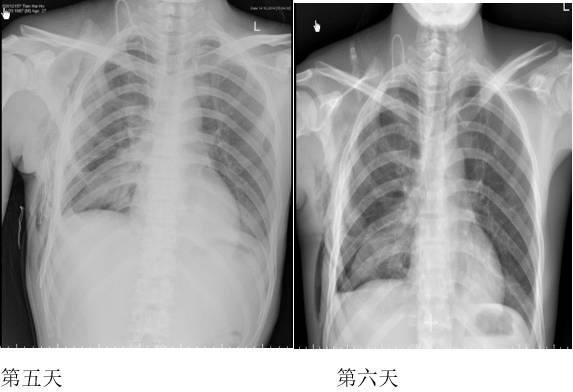 胸部影像学征象——肺部 胸部影像学征象——肺部