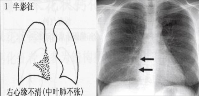 胸部影像学征象——肺部"剪影征"