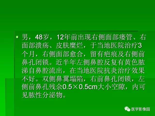 【病例】鼻腔淋巴瘤1例CT影像表现