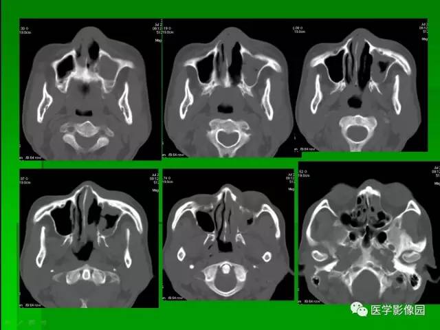 【病例】鼻腔淋巴瘤1例CT影像表现 【病例】鼻腔淋巴瘤1例CT影像表现