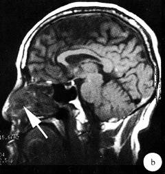 【病例】鼻中隔脓肿1例CT及MR影像解析 【病例】鼻中隔脓肿1例CT及MR影像解析