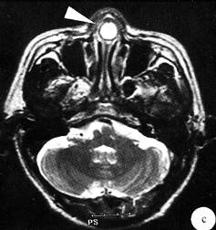 【病例】鼻中隔脓肿1例CT及MR影像解析 【病例】鼻中隔脓肿1例CT及MR影像解析