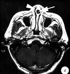 【病例】鼻中隔脓肿1例CT及MR影像解析 【病例】鼻中隔脓肿1例CT及MR影像解析