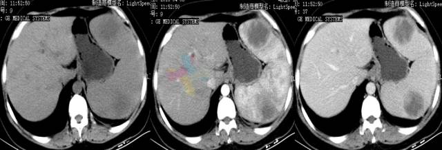 脾脏常见病变影像 脾脏常见病变影像