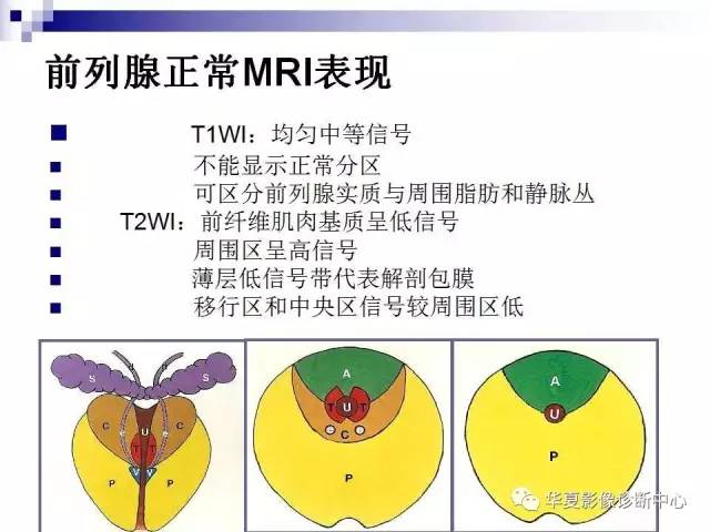 【PPT】前列腺癌的MRI诊断