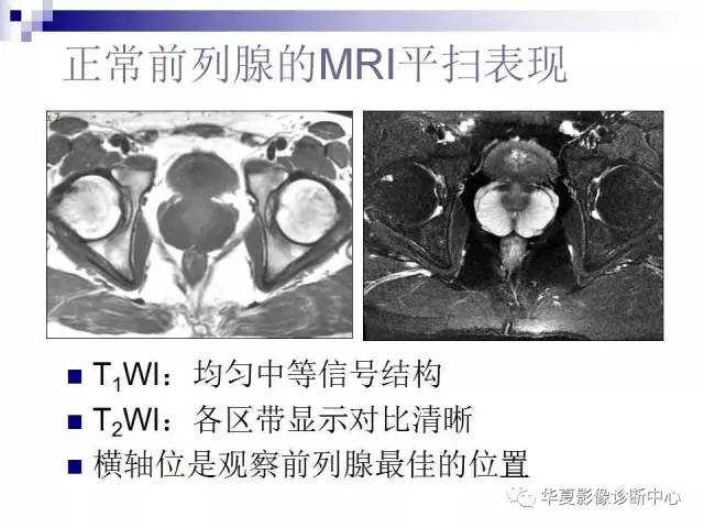 【PPT】前列腺癌的MRI诊断