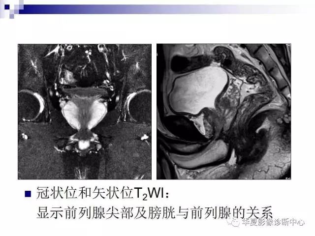 【PPT】前列腺癌的MRI诊断