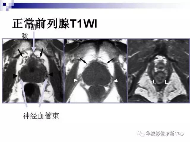 【PPT】前列腺癌的MRI诊断