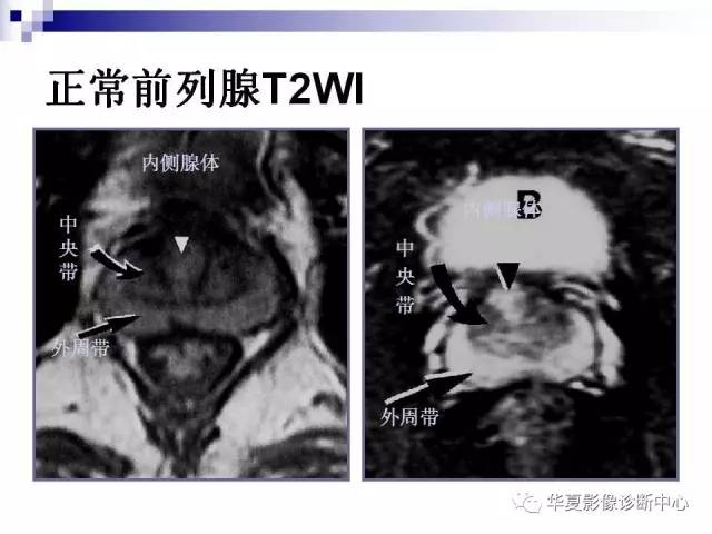 【PPT】前列腺癌的MRI诊断