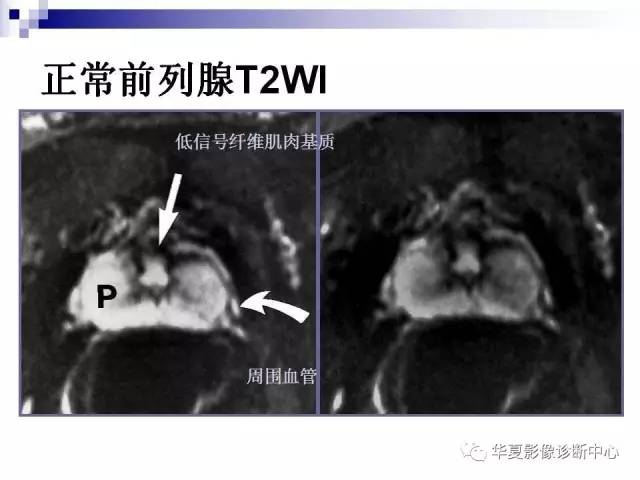 【PPT】前列腺癌的MRI诊断