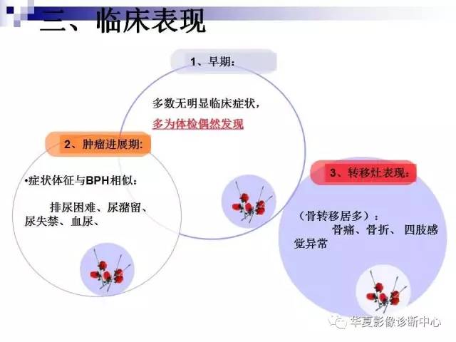 【PPT】前列腺癌的MRI诊断