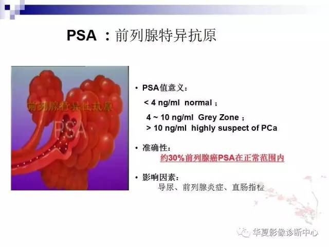 【PPT】前列腺癌的MRI诊断