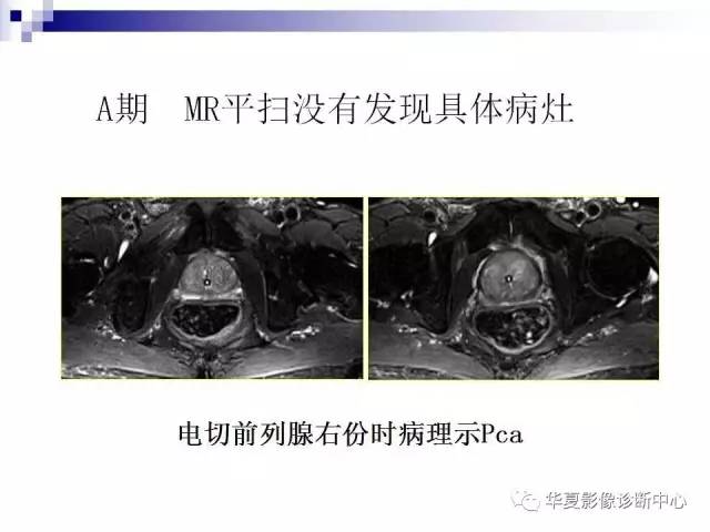 【PPT】前列腺癌的MRI诊断