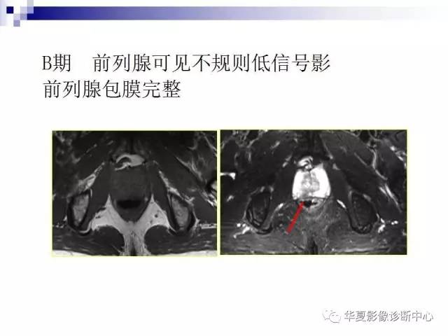 【PPT】前列腺癌的MRI诊断