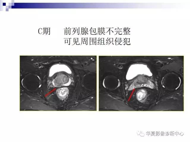 【PPT】前列腺癌的MRI诊断
