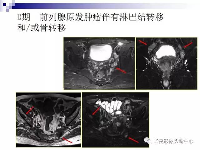 【PPT】前列腺癌的MRI诊断