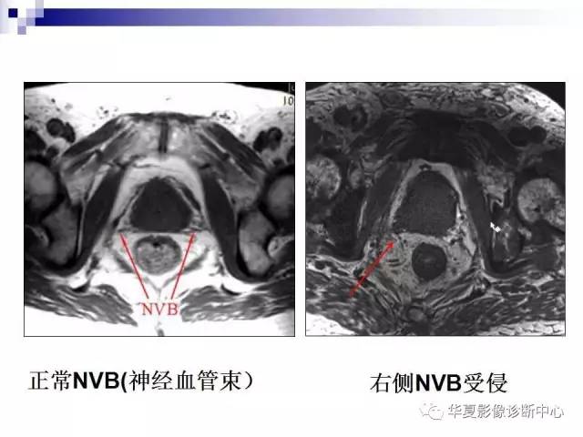 【PPT】前列腺癌的MRI诊断