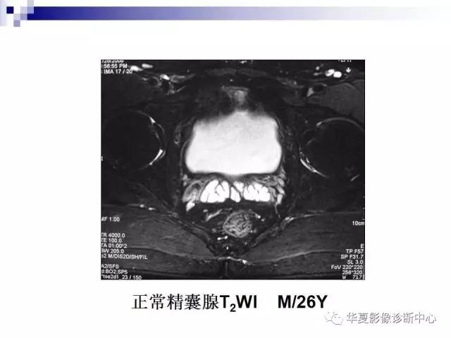 【PPT】前列腺癌的MRI诊断