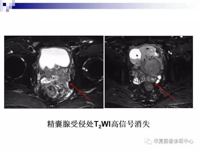 【PPT】前列腺癌的MRI诊断