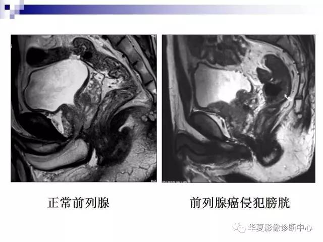 【PPT】前列腺癌的MRI诊断
