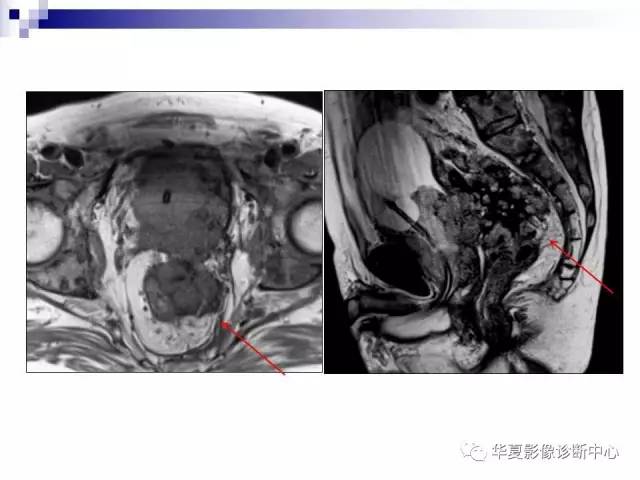 【PPT】前列腺癌的MRI诊断