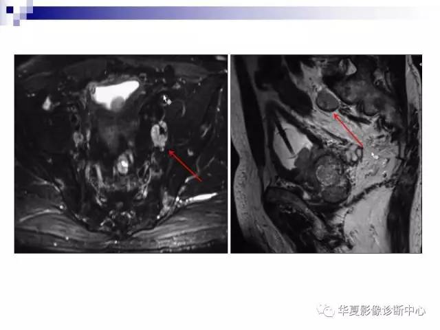 【PPT】前列腺癌的MRI诊断