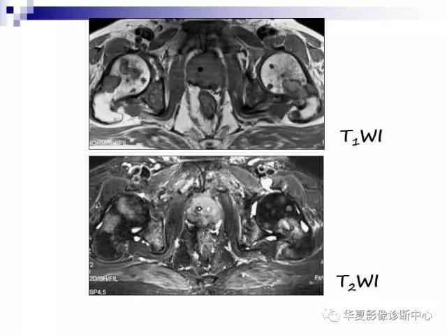 【PPT】前列腺癌的MRI诊断