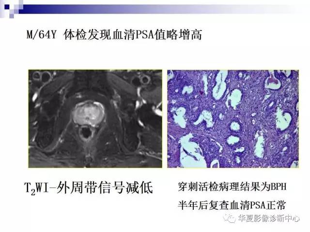 【PPT】前列腺癌的MRI诊断