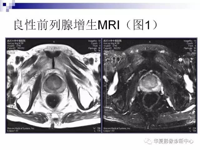 【PPT】前列腺癌的MRI诊断